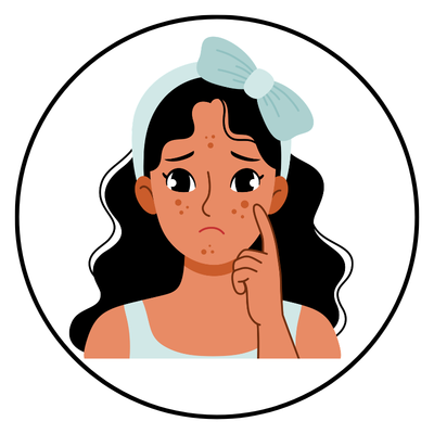 Acne Treatment